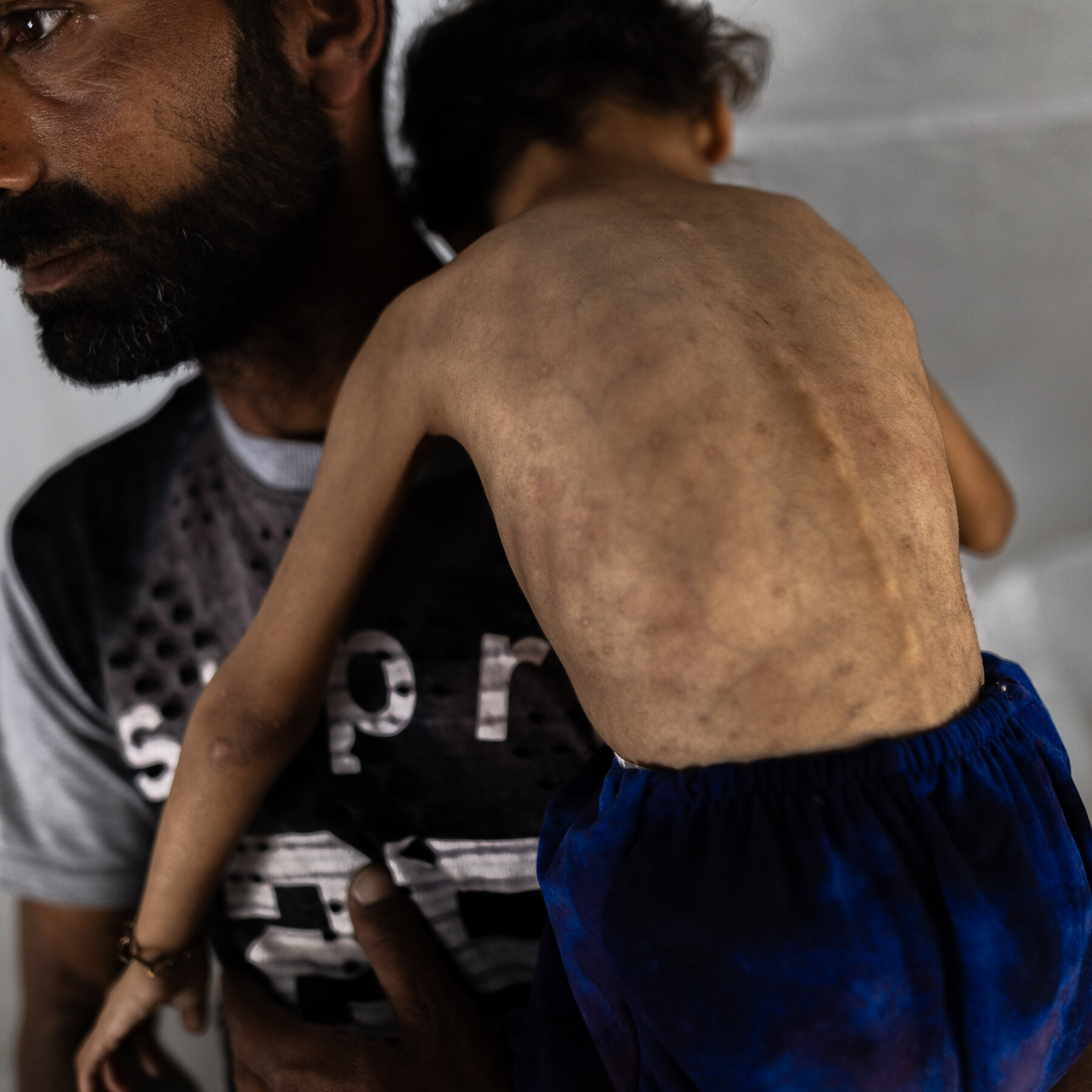In Gaza’s Emaciated Children, a Hunger Crisis Is Laid Bare
